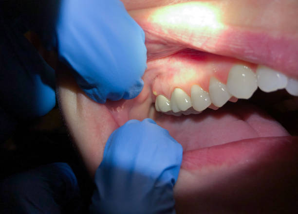 Best Emergency Dental Care for Sports Injuries in West Middlesex, PA
